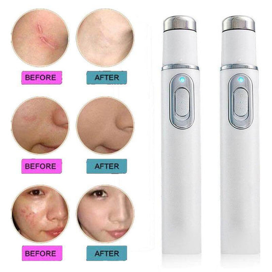Heated Eye Massager For Dark Circles | Acne Removal Pen Skincare Tool